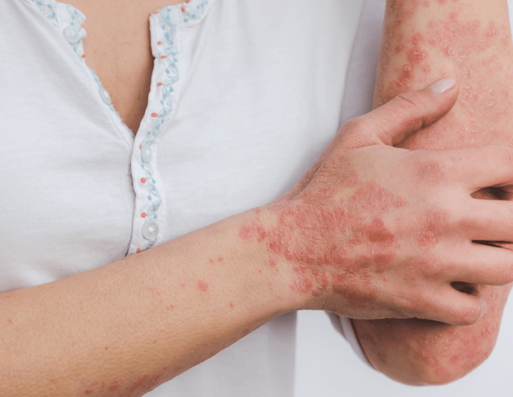 Psoriasis