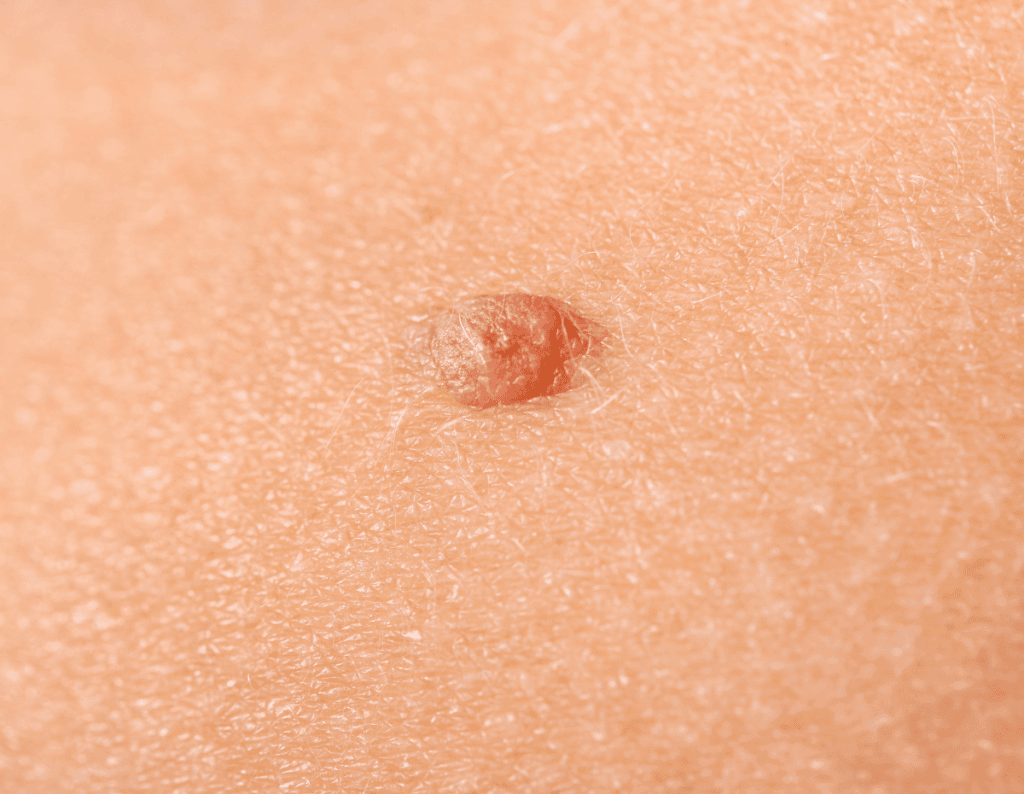 Carcinoma