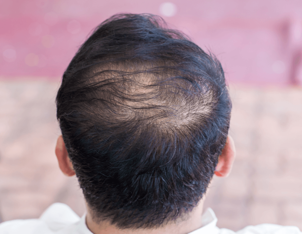Hair Loss