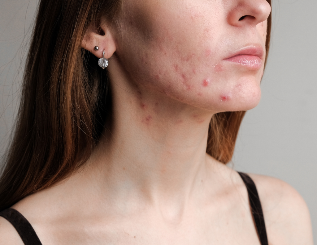 Acne Treatment