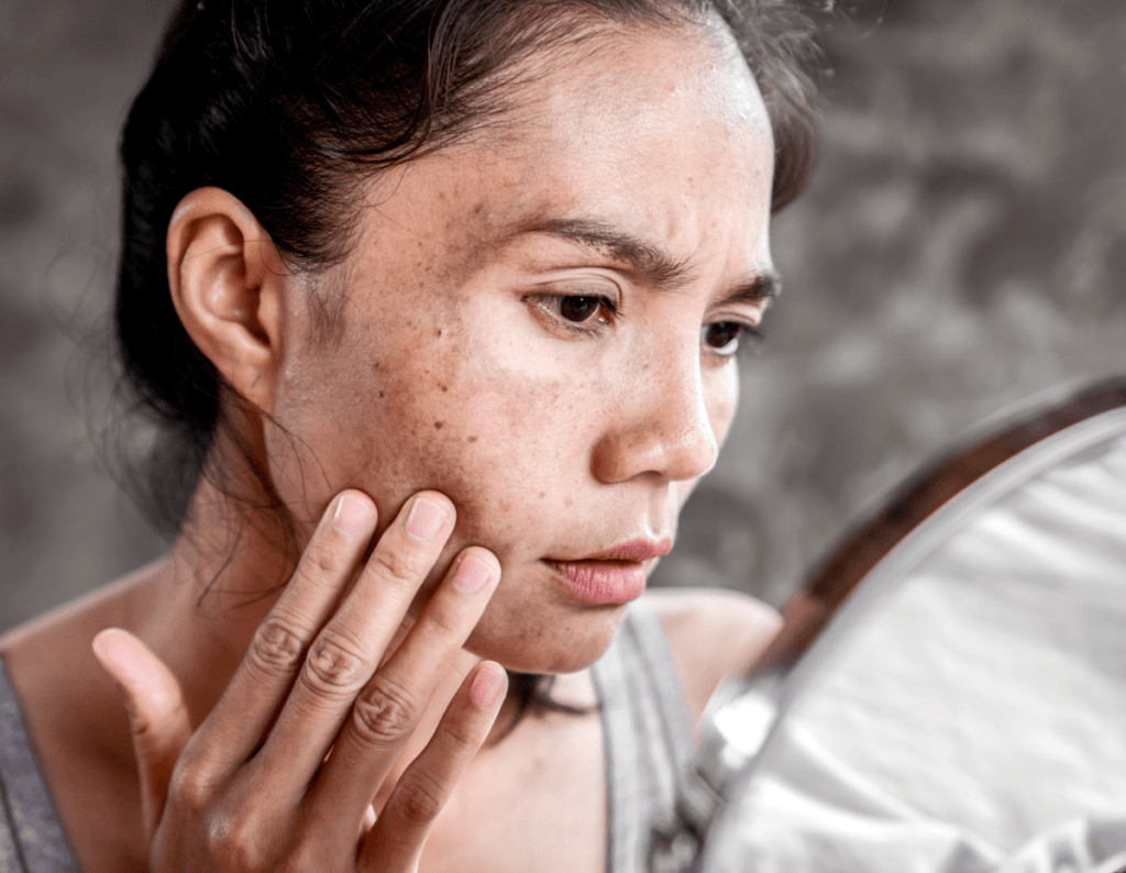 Hyperpigmentation