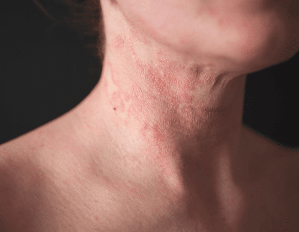 Eczema