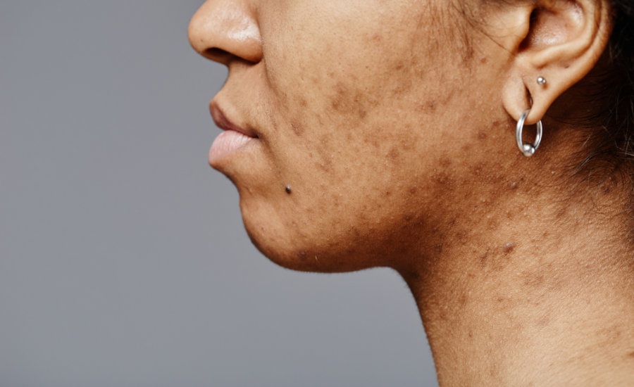 skin pigmentation